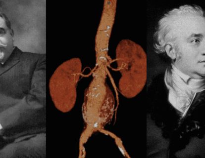 Abdominal (Karın) Aort Ligasyonu 1817 – Karın Damarını Bağlamak