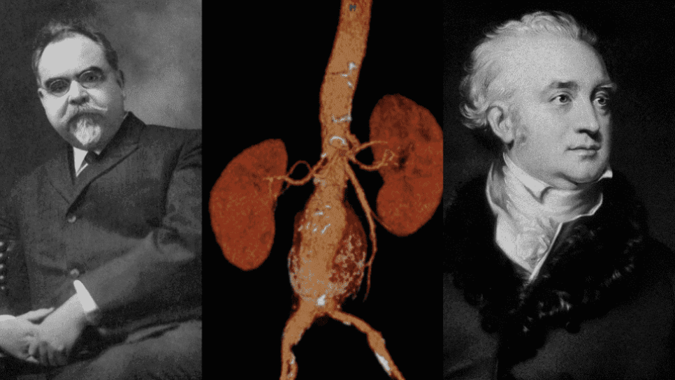 Abdominal (Karın) Aort Ligasyonu 1817 – Karın Damarını Bağlamak