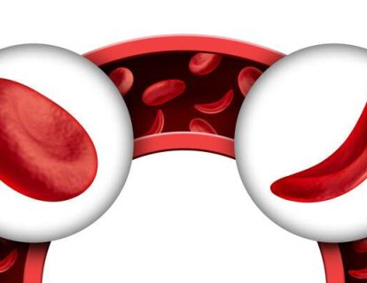 Orak hücreli anemi tedavisi için ilk kez bir ilaç FDA onayı aldı!