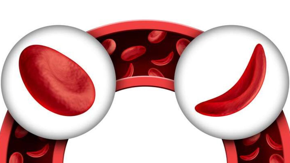 Orak hücreli anemi tedavisi için ilk kez bir ilaç FDA onayı aldı!