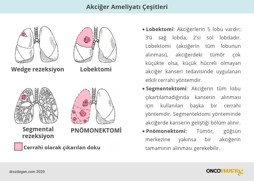 akciger ameliyati cesitleri pnomonektomi segmentektomi lobektomi 880480