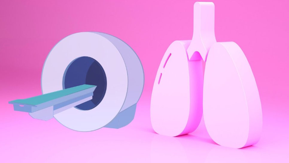 20-Year Survival Reaches 80 Percent in Patients Diagnosed Through Lung Cancer Screening
