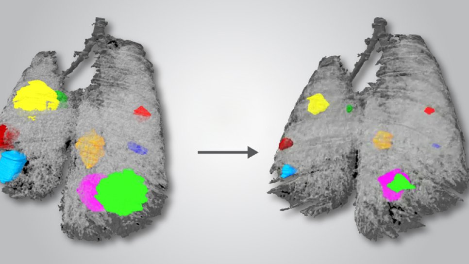 First Treatment Specific to MET Mutations in Lung Cancer Receives FDA Approval: Capmatinib
