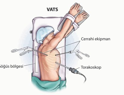 Akciğer Kanserinde Minimal Cerrahi (VATS), Açık Lobektomiye Göre Yaşam Süresini Uzatıyor