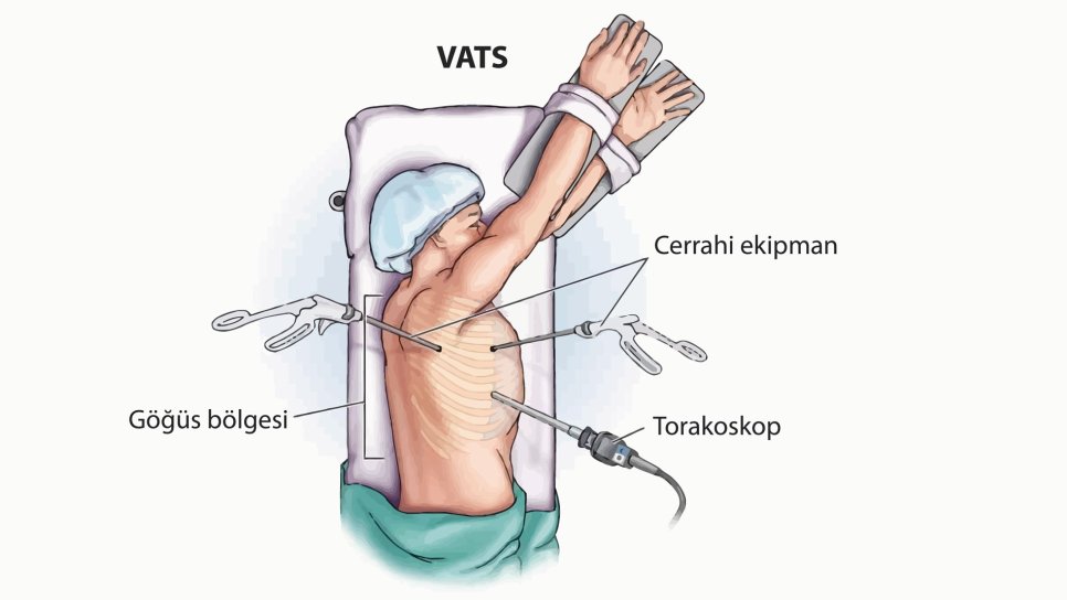 Akciğer Kanserinde Minimal Cerrahi (VATS), Açık Lobektomiye Göre Yaşam Süresini Uzatıyor