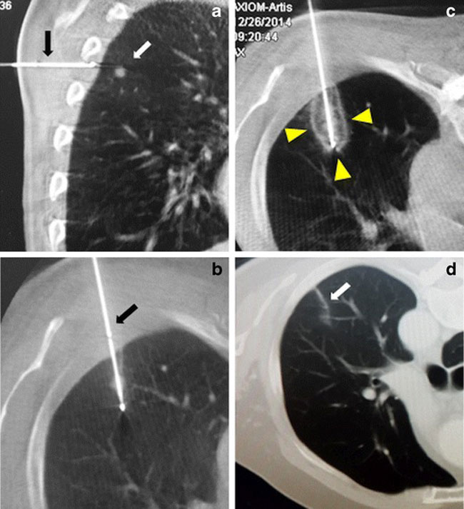 Cryoablation freezing treatment for a lung metastasis