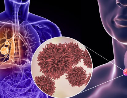 Akciğer ve tiroid kanserlerinde görülebilen RET mutasyonuna yönelik İLK TEDAVİ FDA onayı aldı: Selpercatinib