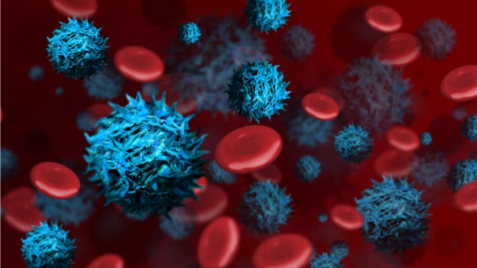 Akut Miyeloid Lösemi (AML) nedir? Belirtileri ve tedavisi