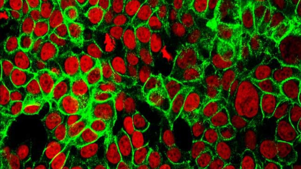 Akut miyeloid lösemi tedavisinde yeni FDA onayı: Onureg