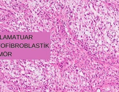 ALK-pozitif İnflamatuar Miyofibroblastik Tümör için Krizotinib FDA Onayı Aldı