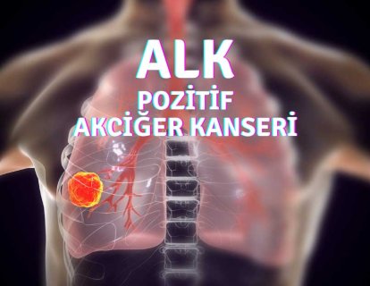ALK Pozitif Ne Demek? ALK Mutant Akciğer Kanseri Başlangıç Tedavileri Karşılaştırması