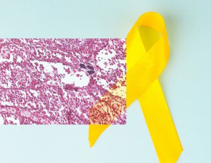 Alveolar Yumuşak Doku Sarkomu için Atezolizumab İmmünoterapisi FDA Onayı Aldı