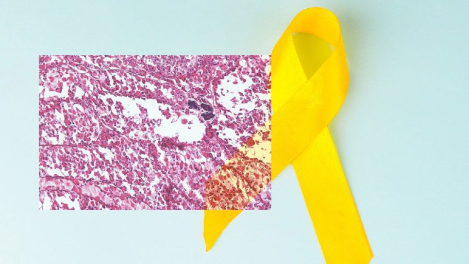 Alveolar Yumuşak Doku Sarkomu için Atezolizumab İmmünoterapisi FDA Onayı Aldı
