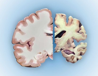 Alzheimer Hastalığı1906 – Auguste Deter'in Otopsisi