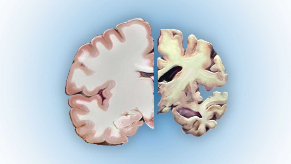 Alzheimer xəstəliyi 1906 – Auguste Deterin autopsiyası