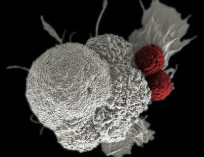 Ameliyatla Çıkarılamayan veya 4. Evre Melanom için Opdualag FDA Onayı Aldı