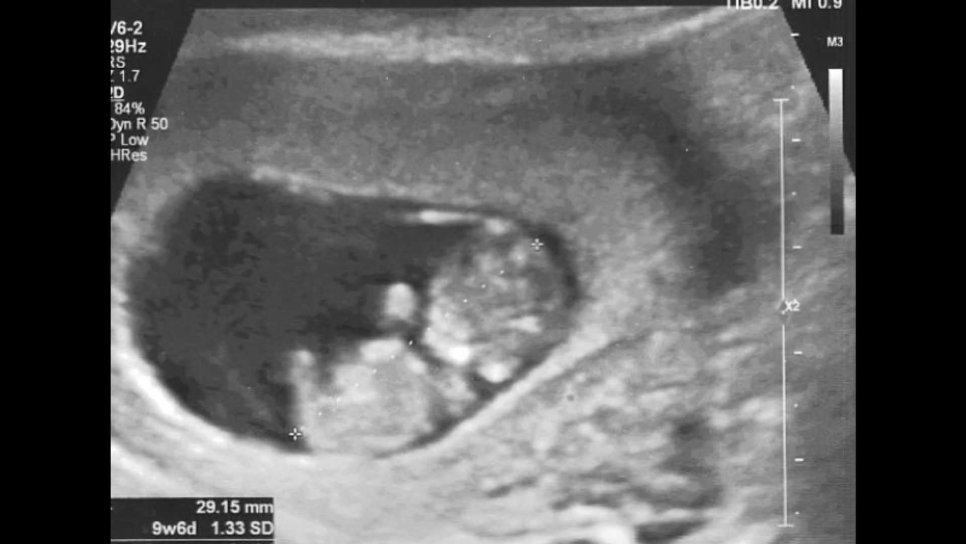 Amniozentese 1952 – Gesundheitskontrolle des Kindes im Mutterleib
