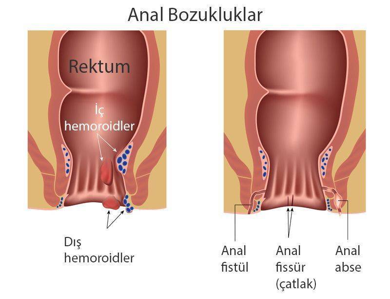 anal bozukluklar ic hemoroid dis basur anal fissur fistul abse 779210