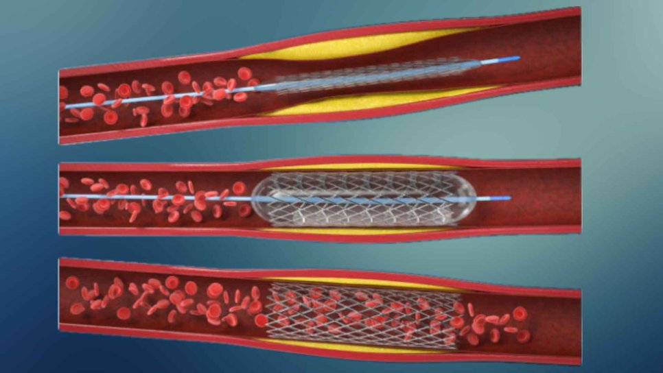 Angioplastika 1964 – Tıxanmış və daralmış qan damarlarının müalicəsi