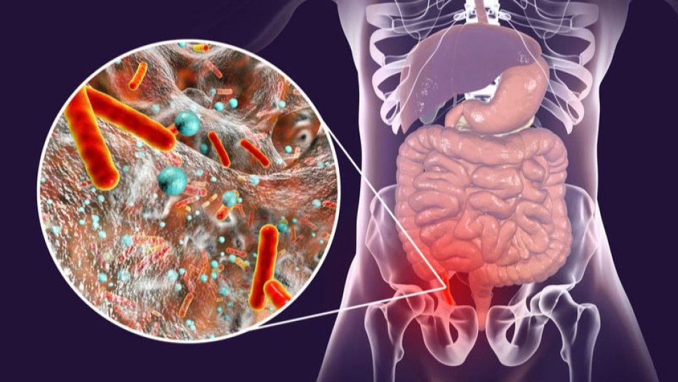 Apendicectomia (operația pentru apendicită) crește riscul de cancer colorectal?