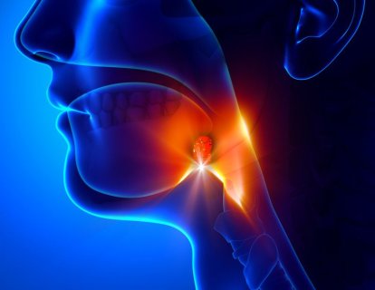 Bademcikte Kanser Nasıl Oluşur? Bademcik (Tonsil) Kanseri Belirtileri ve Tedavisi