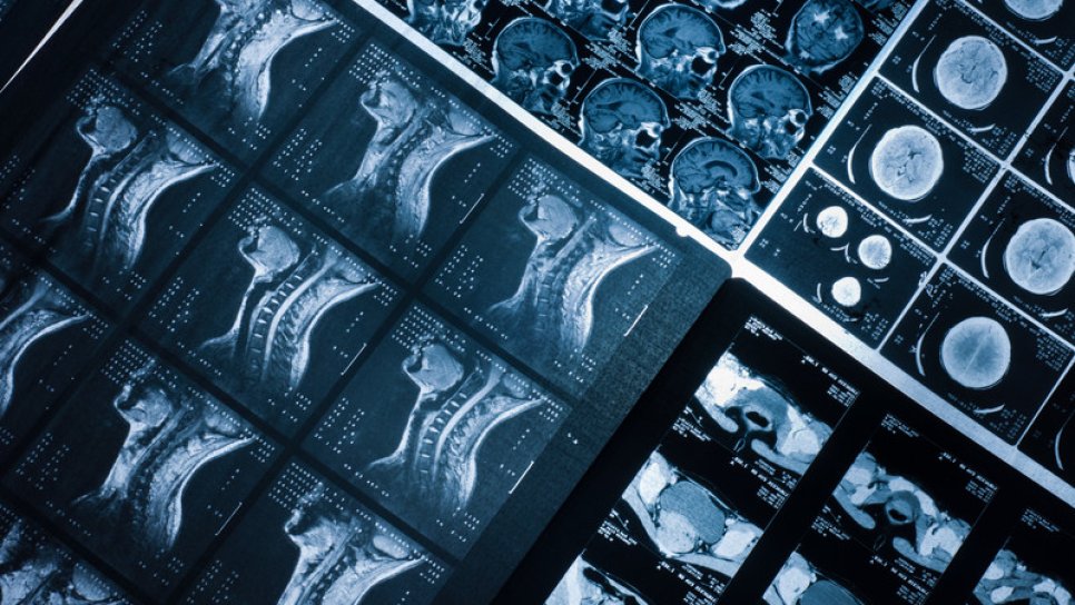 Eine neue Behandlungsoption bei Kopf-Hals-Krebs durch Immuntherapie und Strahlentherapie