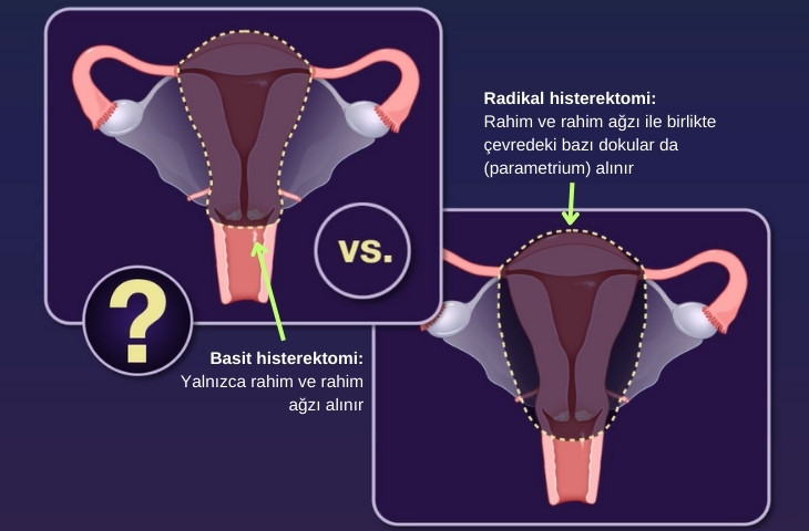 What Are Simple and Radical Hysterectomy? A Comparison