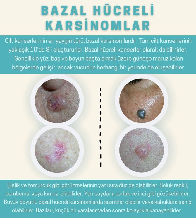 bazal hucreli karsinom cilt kanseri fotograflari 1 389231