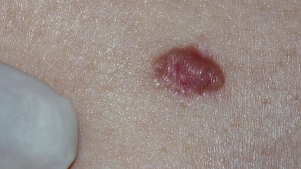 Basalzellkarzinom – Diagnose, Behandlung und Vorbeugung