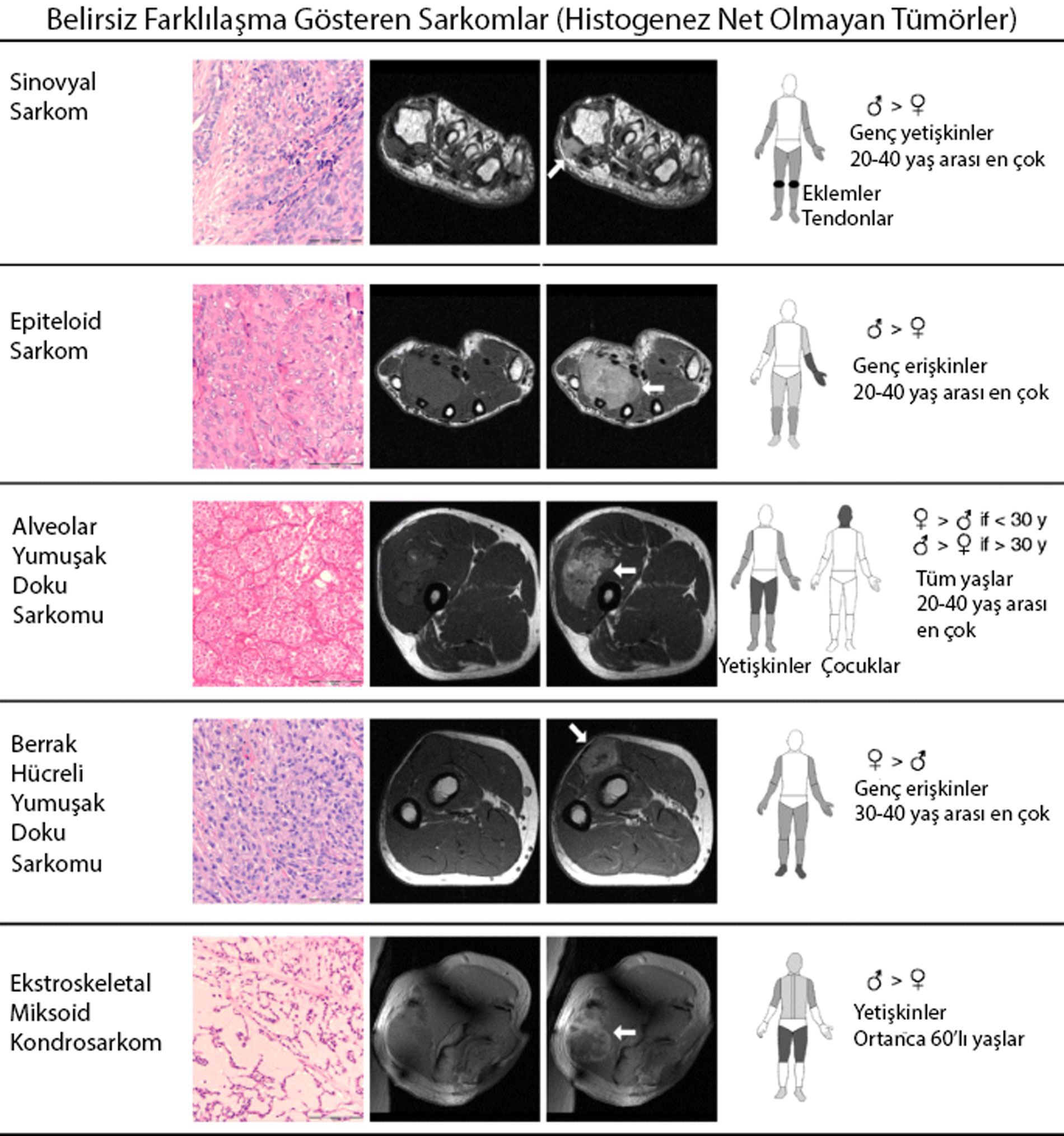 belirsiz farklilasma gosteren sarkomlar histogenez net olmayan tumorler 211370