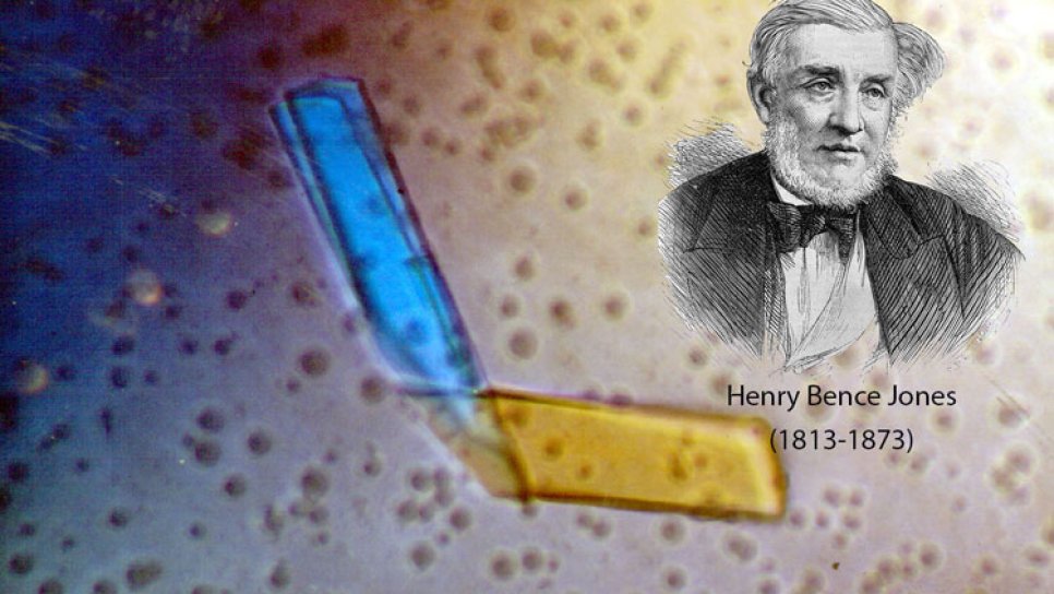 Bence Jones Proteini Nedir İsmi Nereden Gelmektedir