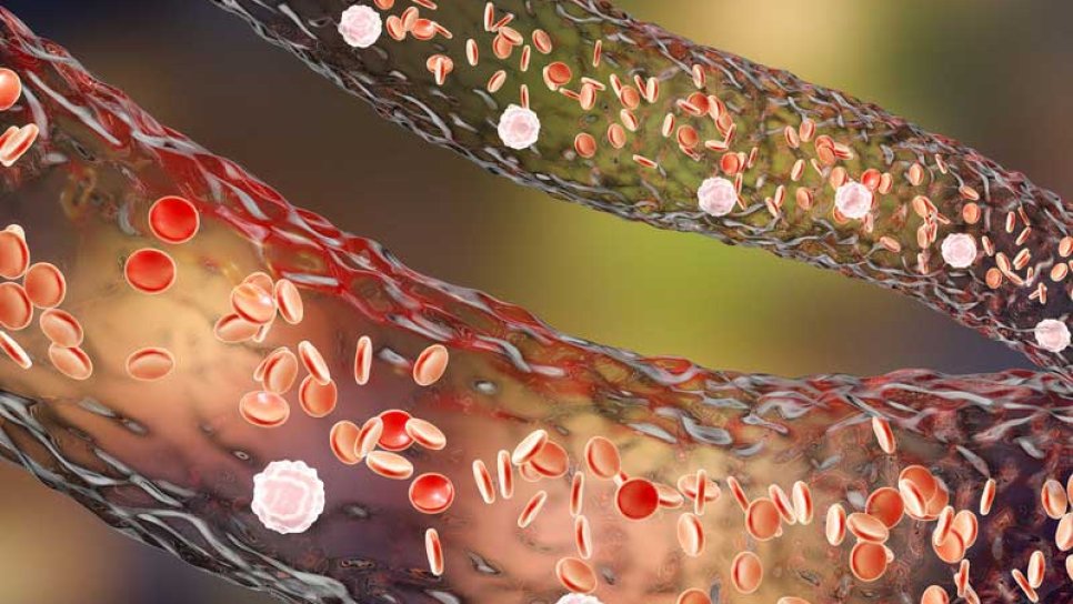 Bevasizumab (Altuzan, Zirabev) nedir, hangi kanserin tedavisinde kullanılır, yan etkileri?