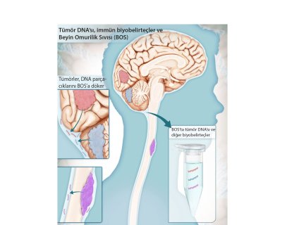 Beyin Tümörlerinin Tanısında Önemli Gelişme: Beyin Omurilik Sıvısı Testi CSF-BAM