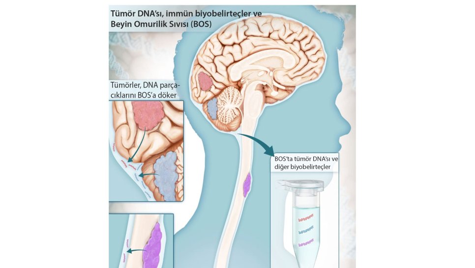 Beyin Tümörlerinin Tanısında Önemli Gelişme: Beyin Omurilik Sıvısı Testi CSF-BAM