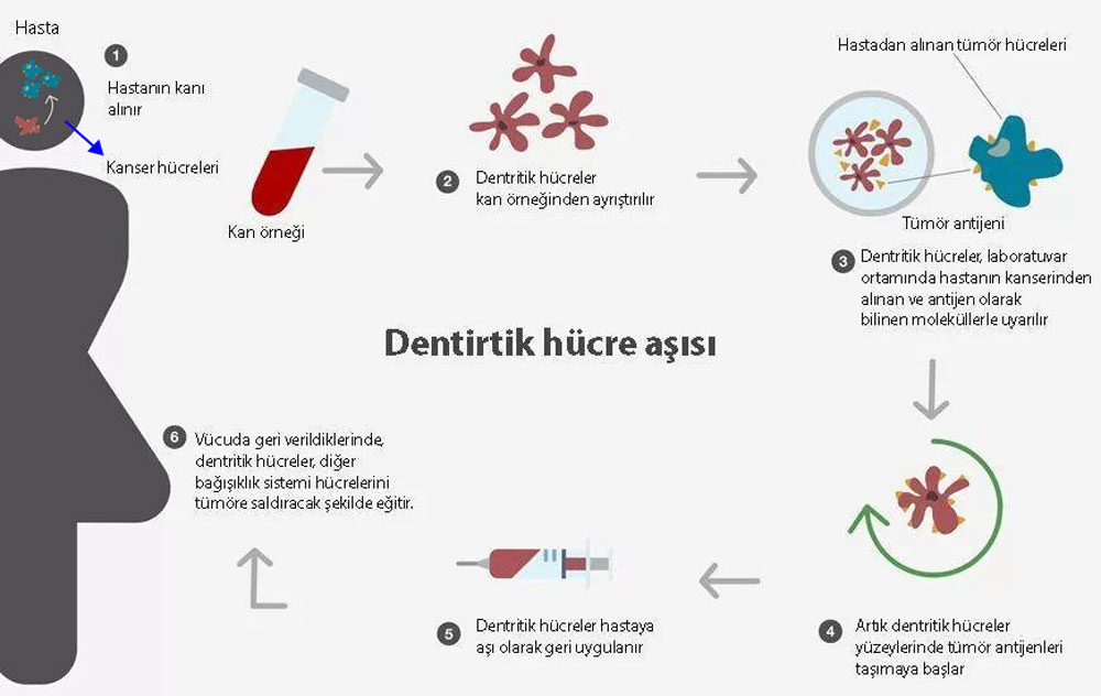 Dendritischer Zellimpfstoff gegen den Hirntumor Glioblastom (GBM)
