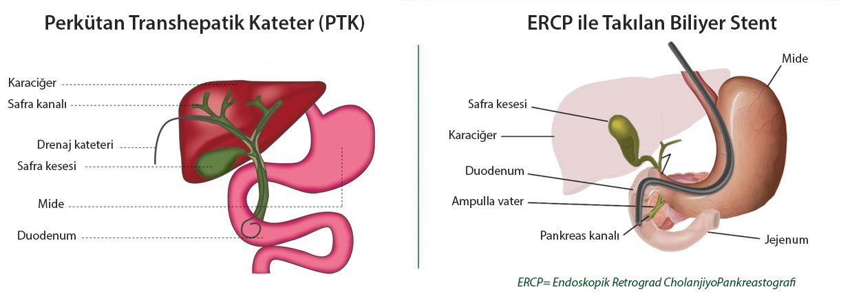 biliyer stent ve ptk perkitan biliyer kateter nedir farklari safra kanali tikanikligi 549131