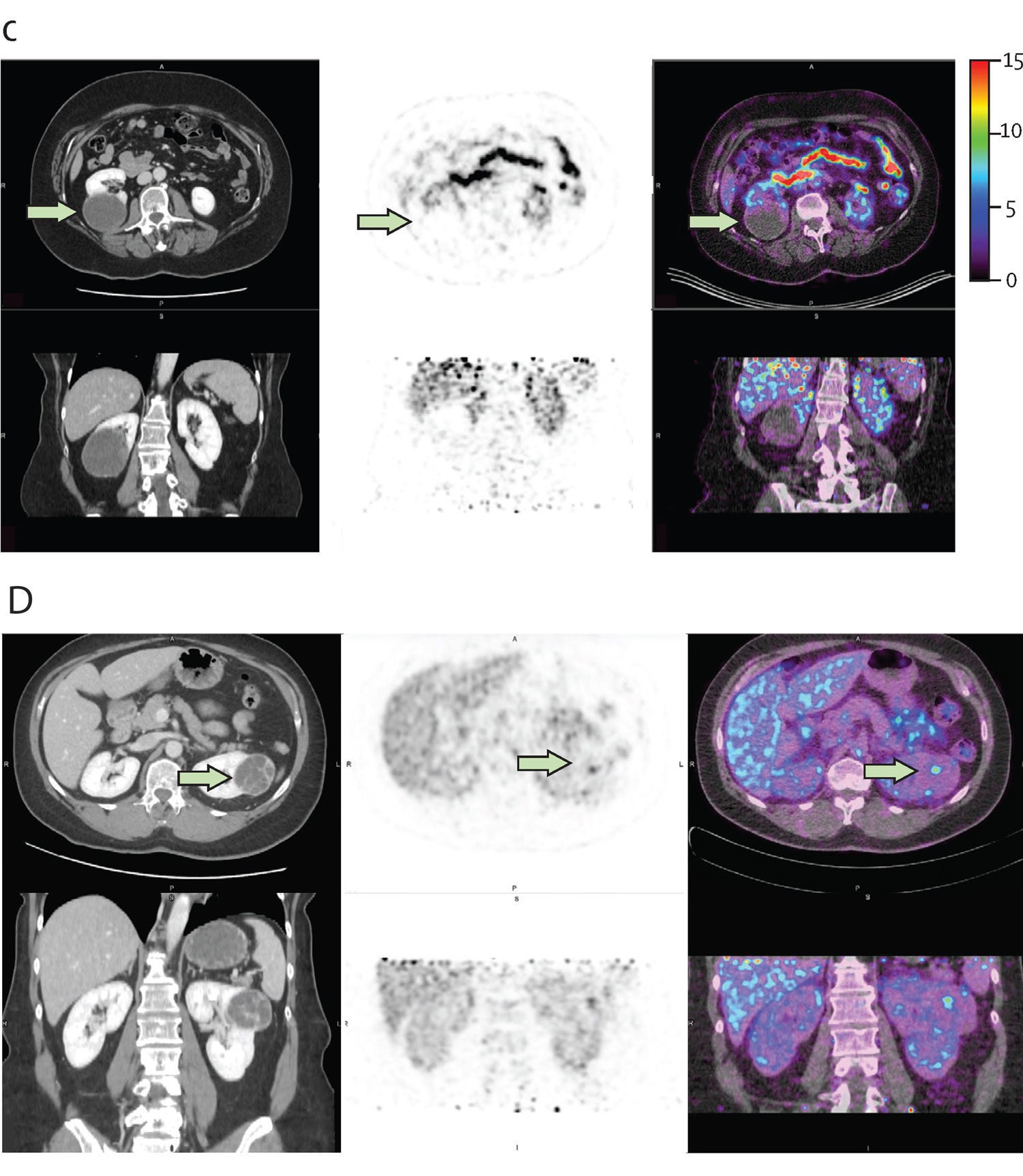 Примеры пациентов, демонстрирующие эффективность 89Zr Zr girentuximab PET CT в диагностике поражений почки, 2
