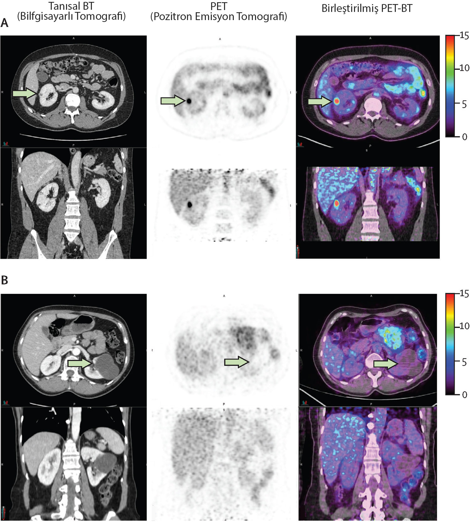bobrek lezyonlarinin tanisinda 89zr zr girentuximab pet ct etkinligini gosteren hasta ornekleri 239