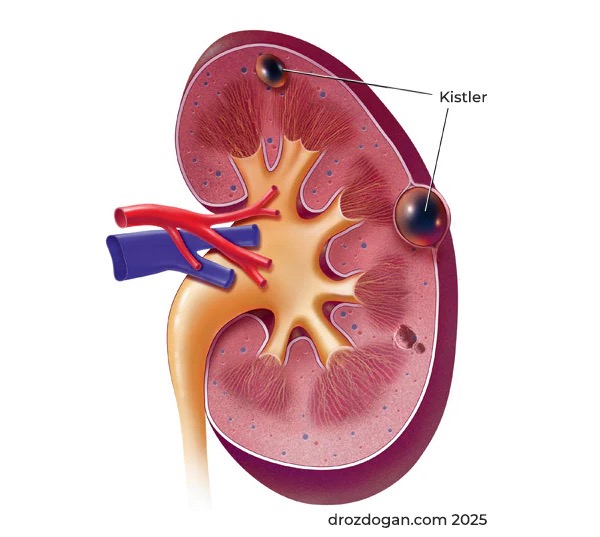 What is a Bosniak cyst?