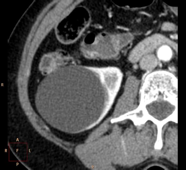 What is a Bosniak cyst?