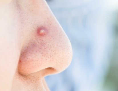 Burunda Kırmızı Nokta, Yara, Sivilce ve Lekeler Ne Anlama Gelir?