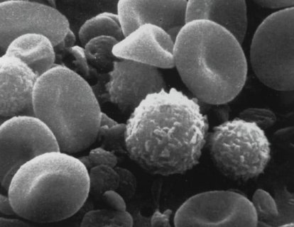 Büyük B Hücreli Lenfoma İkinci Basamak Tedavisinde CAR T-hücre (Yescarta) FDA Onayı Aldı