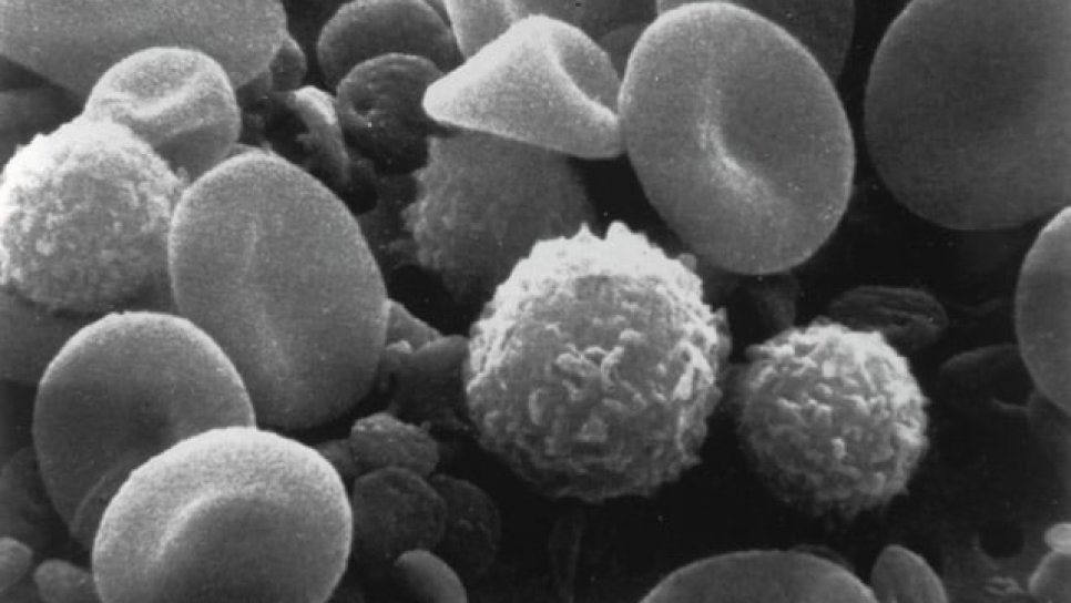 Büyük B Hücreli Lenfoma İkinci Basamak Tedavisinde CAR T-hücre (Yescarta) FDA Onayı Aldı