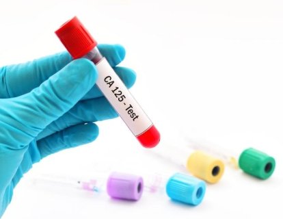 CA-125 Testi Nedir? Yüksekliği Hangi Kanserlerde Görülür? Normal Değeri Kaç Olmalı?