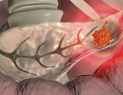 Yeni bir CAR T-hücre immünoterapisi, pankreas kanseri tedavisi için umut vermekte