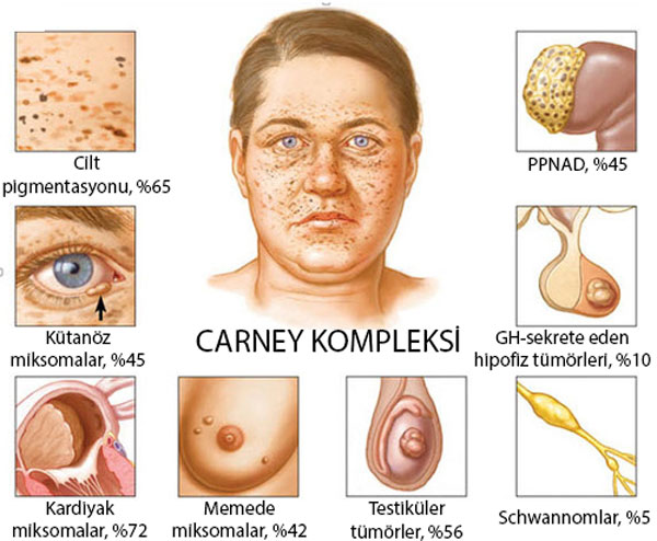 carney kompleksi nedir belirtileri 596477