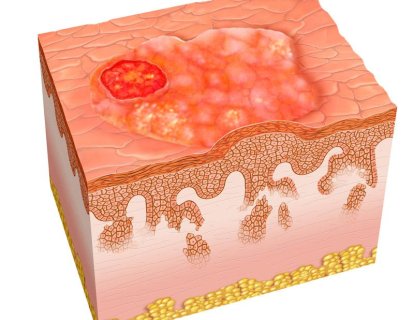 Yassı Hücreli Cilt Kanseri Tedavisi İçin FDA Onayı Alan İlk İlaç: Cemiplimab