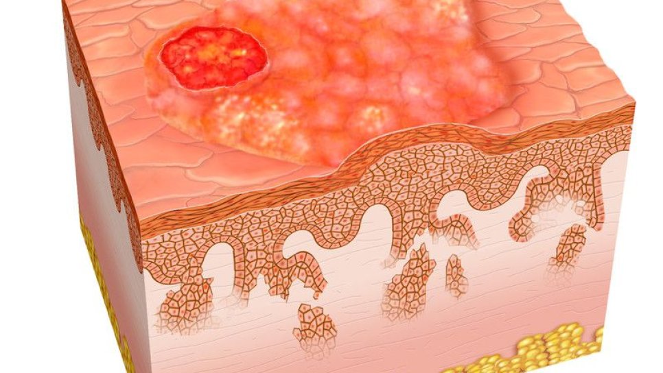 Yassı Hücreli Cilt Kanseri Tedavisi İçin FDA Onayı Alan İlk İlaç: Cemiplimab