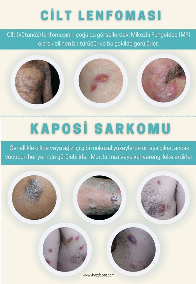 عکسهای لنفوم پوستی و سارکوم کاپوزی