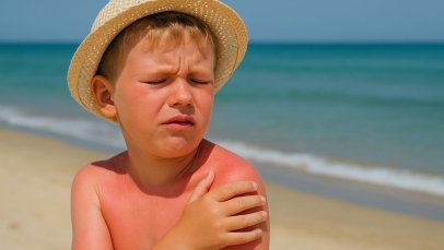 Çocuklukta Güneş Yanıkları, Melanom Riskini Artırıyor: Yeni Çalışma Ne Diyor?